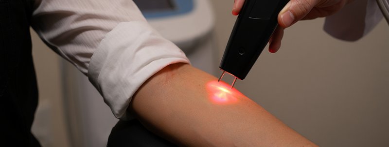 Проведение лазерного кодирования